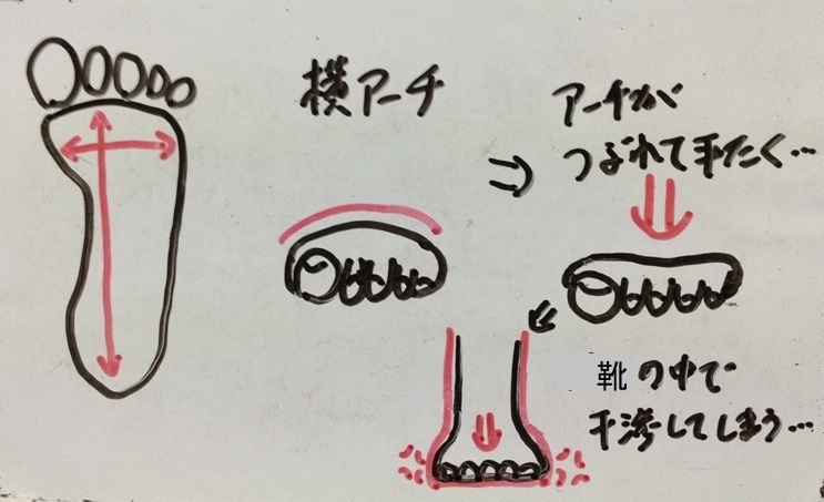 外反母趾になる足　解説