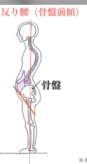 反り腰姿勢　骨格