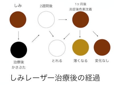 しみ治療経過