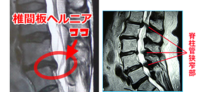 椎間板ヘルニア、脊柱管狭窄症