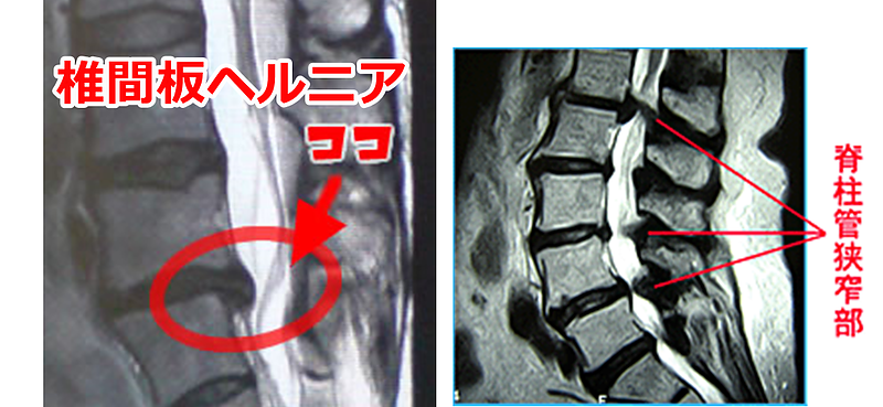椎間板ヘルニア、脊柱管狭窄症